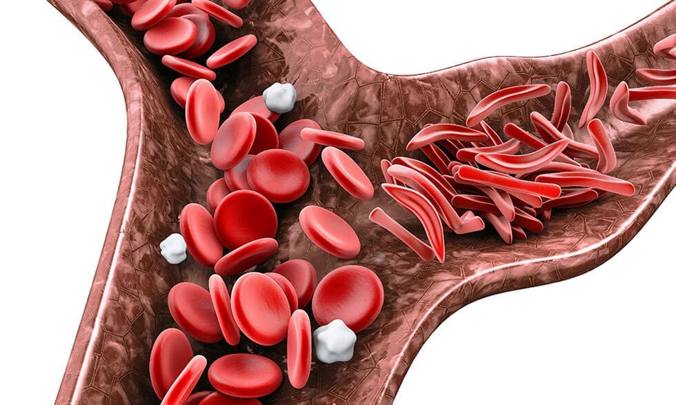 Image of blood cells, some are normal, and others are sickle-shaped and causing a blockage.
