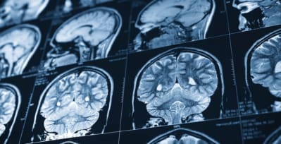 Scans of a human brain showing effects from an ischemic stroke.