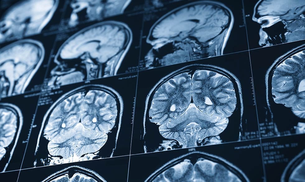 Scans of a human brain showing effects from an ischemic stroke.